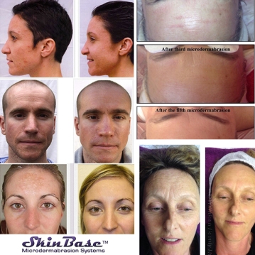 Before and after shots - skinbase